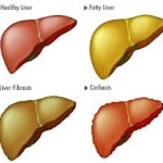 How to Heal Your Fatty Liver